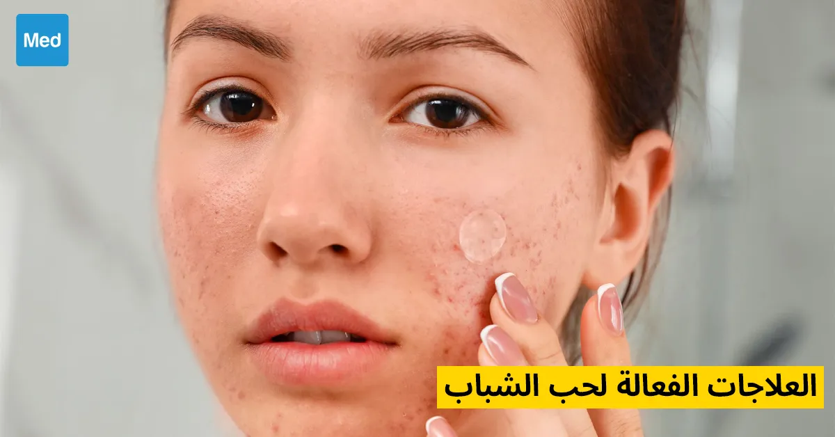 العلاجات الفعالة لحب الشباب